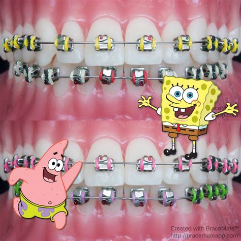 Tell me who you'd like to see in coloured braces #spongebob #squarepants… Braces Teeth Colors ...