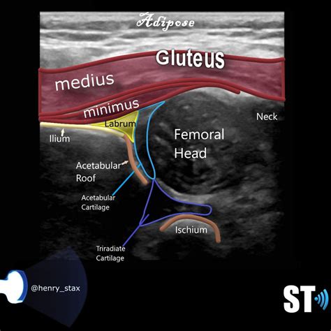 Neonatal Hip Ultrasound | Ultrasound sonography, Ultrasound, Medical ultrasound