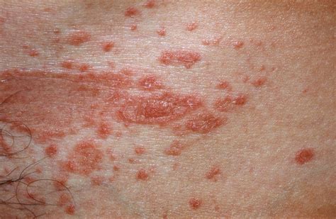 Pityriasis Rosea - Causes, Rash, Herald Patch, Stages, Treatment