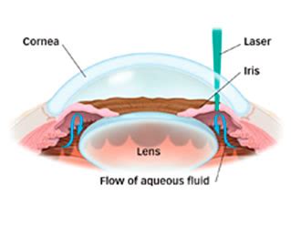 Glaucoma — Eye Surgery Associates | Auckland