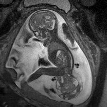 Sacrococcygeal Teratoma (SCT) | Children's Hospital of Philadelphia