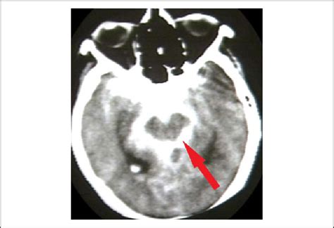 Computed tomography head subarachnoid bleed. The hyperdense bright... | Download Scientific Diagram