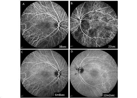 IA at two months after the initial presentation. IA showed delayed... | Download Scientific Diagram