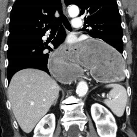 Gastric Volvulus | Radiology Key