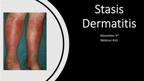 Webinar #10 – Stasis Dermatitis – Recharge Biomedical