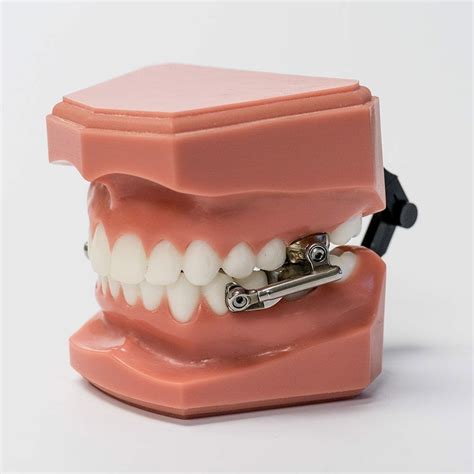 Herbst Appliance - Can Often Correct Severe Overbites without Braces