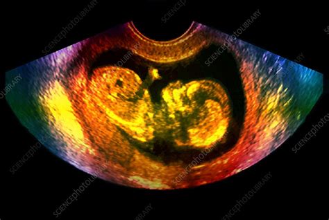 Foetus, ultrasound scan - Stock Image - P680/0601 - Science Photo Library