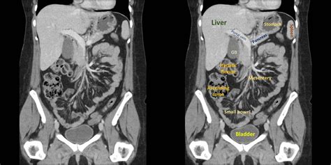 Radiology basics of abdominal CT anatomy with annotated coronal images and scrollable axial ...