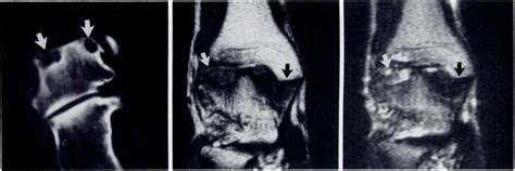 -Pigmented villonodular synovitis (PVNS) of the ankle. A, CT scan of ...