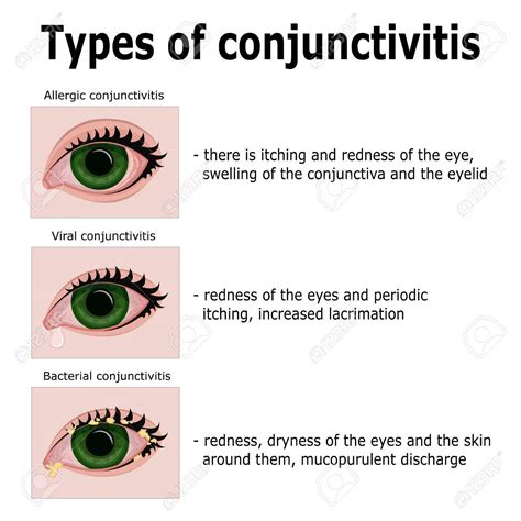 Allergic Conjunctivitis Discharge