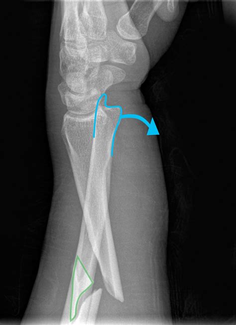 Galeazzi fracture - footryte