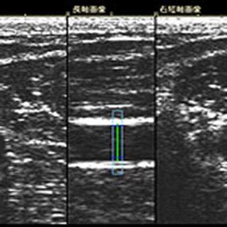 Representative ultrasound image of the brachial artery. Both side... | Download Scientific Diagram