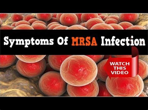 Mrsa Symptoms