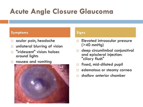 Acute Angle Glaucoma Symptoms