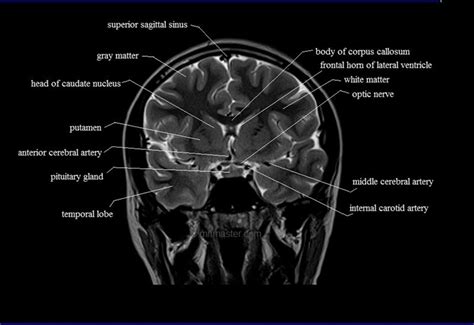 Mri Brain Coronal Cross Sectional Anatomy Image Brain Anatomy Mri | The Best Porn Website