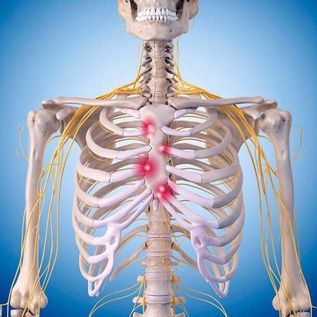 Costochondritis - Physiopedia