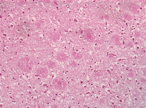 Designer antibodies block Alzheimer’s plaque from forming | FierceBiotech