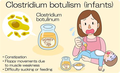 Botulism | Serum therapy