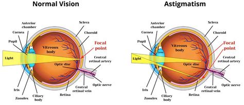 What is Astigmatism and can it be fixed? | LasikPlus | Eye exercises, Astigmatism, Vision eye