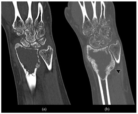 Giant Cell Tumor Mri