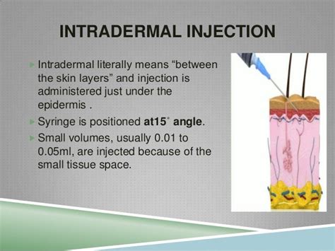 Intradermal Injection Technique