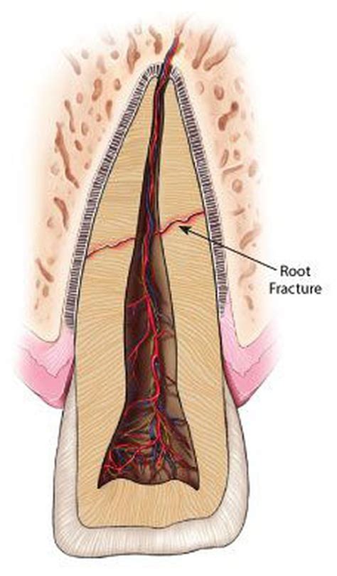 Root fracture - MEDizzy