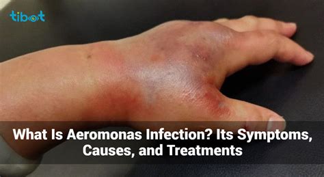 What Is Aeromonas Infection? - Symptoms, Causes & Treatments