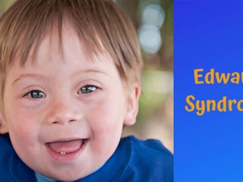 Edwards Syndrome Symptoms