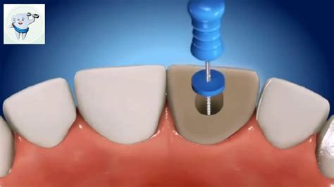 Root Canal Treatment Animation Incisor - YouTube