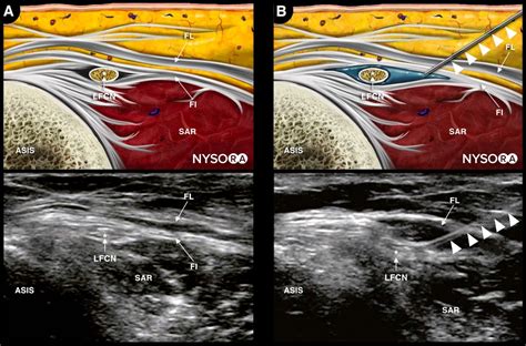 Ultrasound Pain Block Tip of the Week: Lateral Femoral Cutaneous Nerve Block | NYSORA