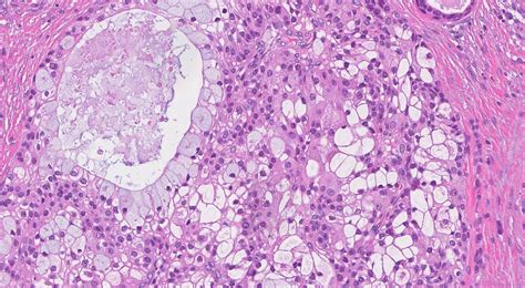 Mucoepidermoid carcinoma | Ottawa Atlas of Pathology