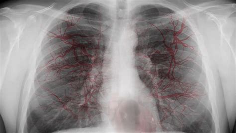 Chest X-ray - Circulatory System. Animation Of Breathing Chest And The ...