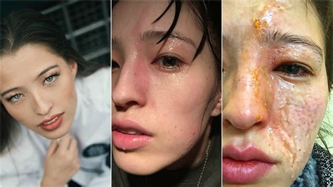 Woman Gets Severely Burned From Essential Oils | Teen Vogue