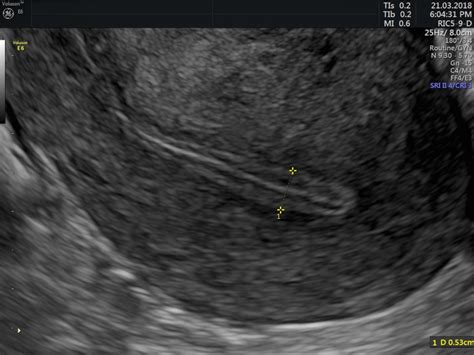 Management of thin endometrium in assisted reproduction: a clinical ...