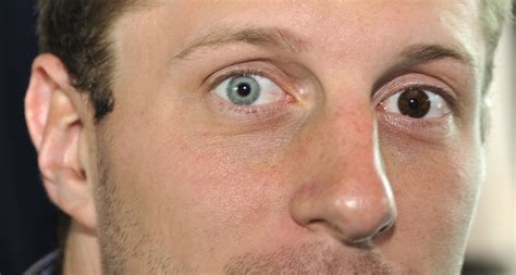 Max Scherzer - Heterochromia