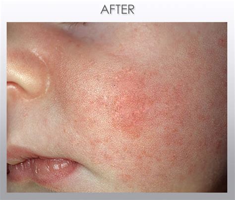 scabies on babies - pictures, photos