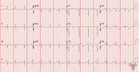 Wellens Syndrome | ECG Stampede