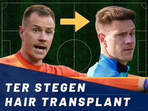 Ter Stegen Hair Transplant - Hair Loss & Technical Analysis