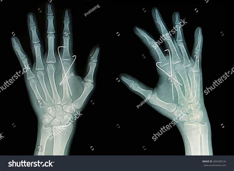 Film Xray Hand Fracture Show Fracture Stock Photo 205498126 | Shutterstock