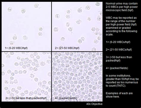 How we report white blood cells count in urinalysis | Medical Laboratories