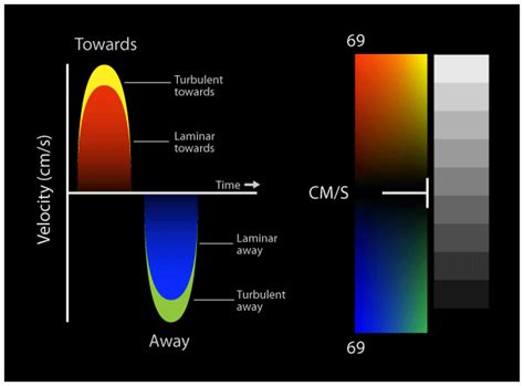 Image result for aliasing in color flow imaging Ultrasound Physics, Vascular Ultrasound ...