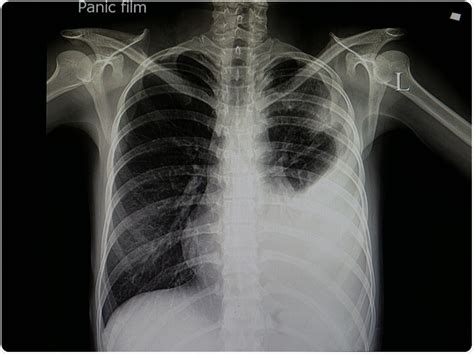 Interstitial Pneumonia X Ray