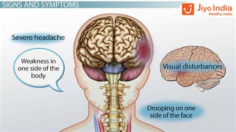 Blood Clot In Brain- Causes, Symptoms, Treatment, And Lot More