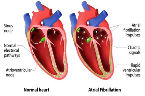 Enfermedades Cardiovasculares