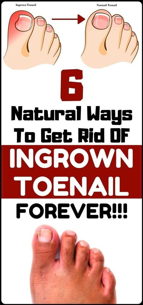 Solve Your Ingrown Toenail With These 6 Natural & Homemade Remedies - Healthy Lifestyle