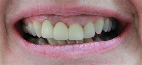 SMILE MAKEOVER WITH IMPLANT BRIDGE - Northland Prosthodontics - Northland Denture Specialist ...