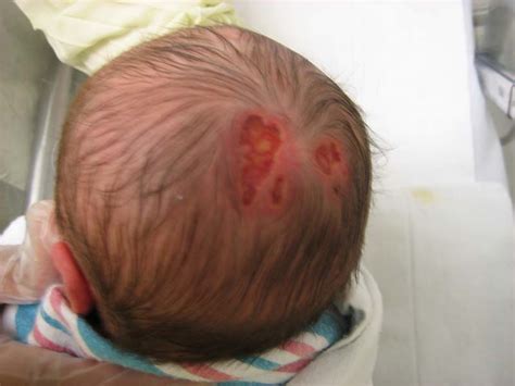 Aplasia Cutis Congenita (congenital skin anomaly)