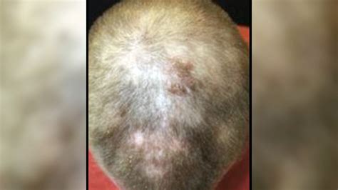 Bald Man Grows Full Head of Hair - NBC News