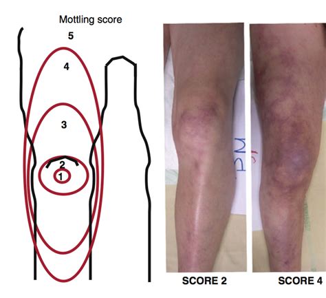 Mottling Score in Sepsis