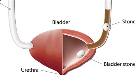 BLADDER STONES - New